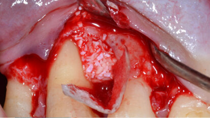 Valutazione di un nuovo inserto ad ultrasuoni in rigenerazione tissutale guidata (GTR)