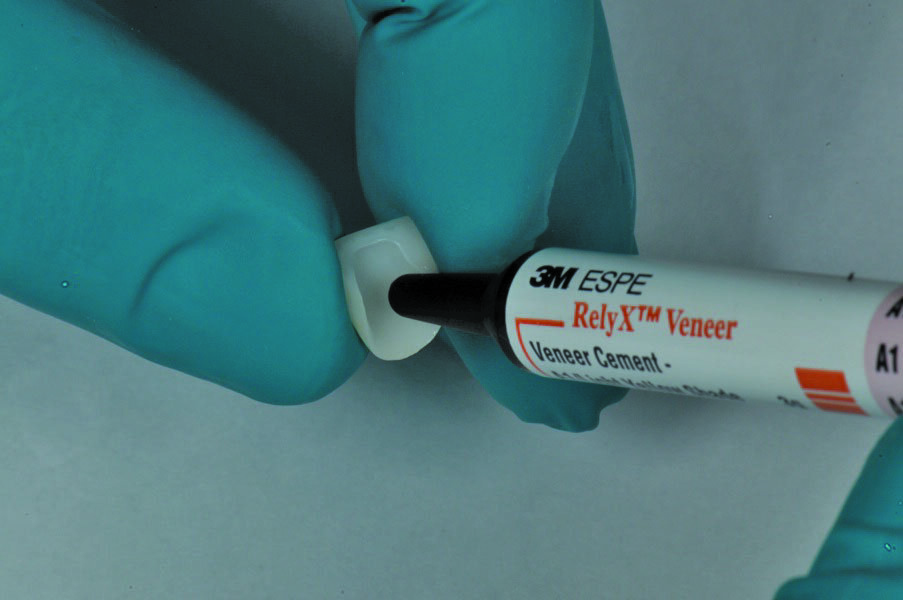 Fig. 18: 3M™ RelyX™ Veneer cement is applied into each of the pretreated veneers.