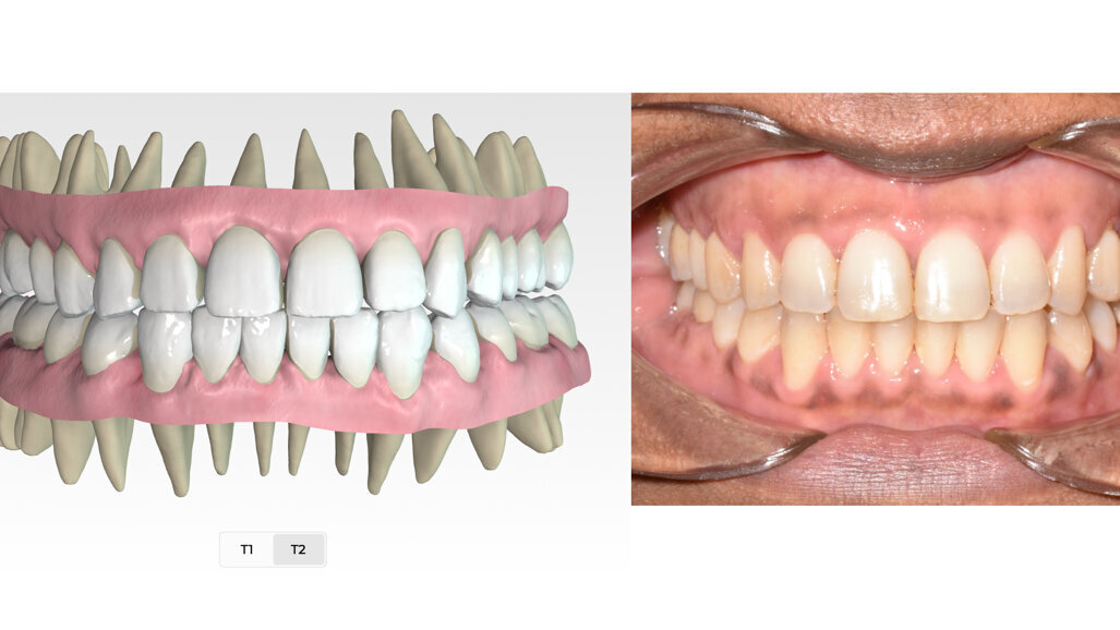 Non-invasive correction of Class III anterior open bite in 7.75 months with clear aligners