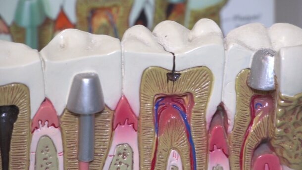 Amalgamat wciąż obecny