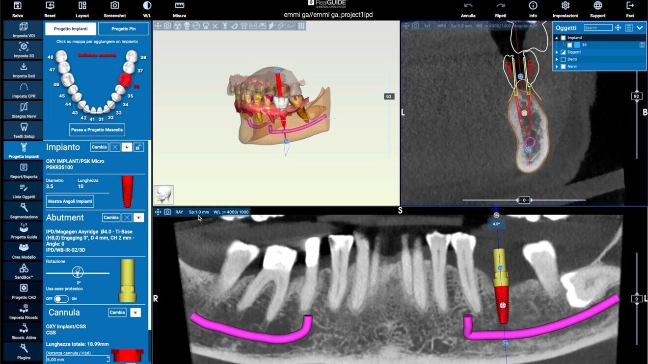 Fig. 3: RealGUIDE software showing the alignment of the STL files with the CBCT data for prosthetically guided planning of the implant position.
