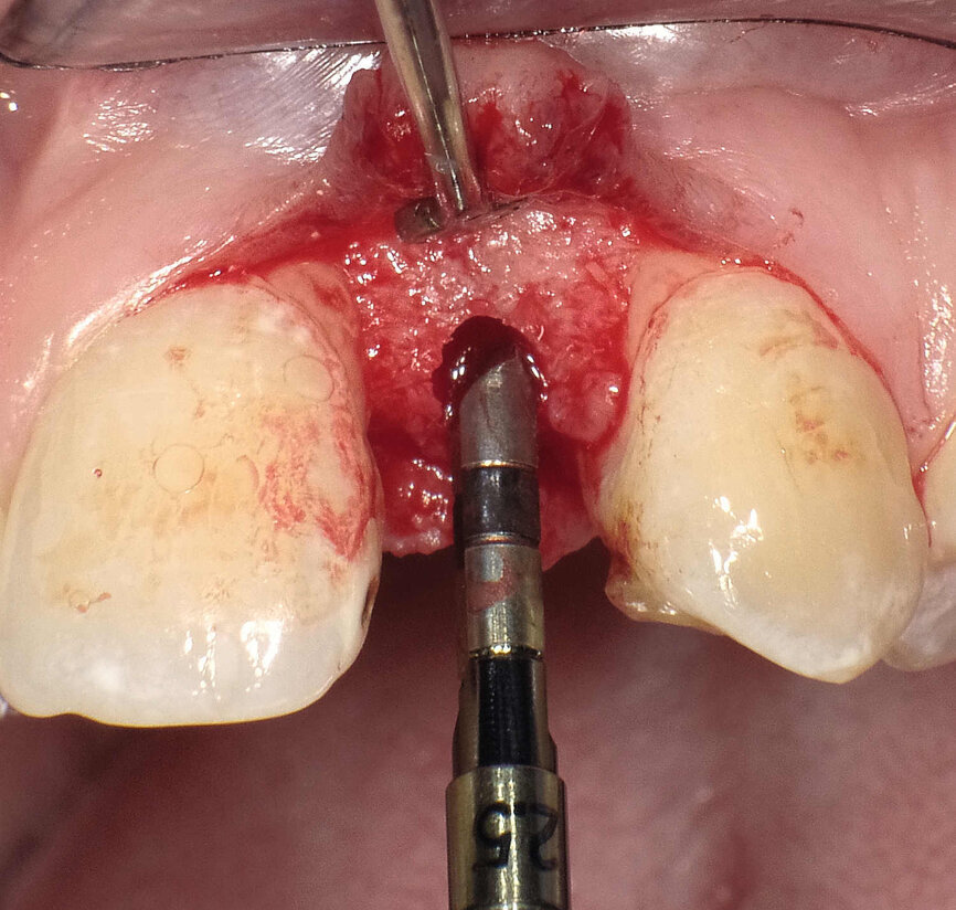 Fig. 3 : Un alésoir manuel de Ø 2,5 mm est utilisé pour élargir l’ostéotomie initiale préparée au moyen du forêt-guide à grande vitesse.