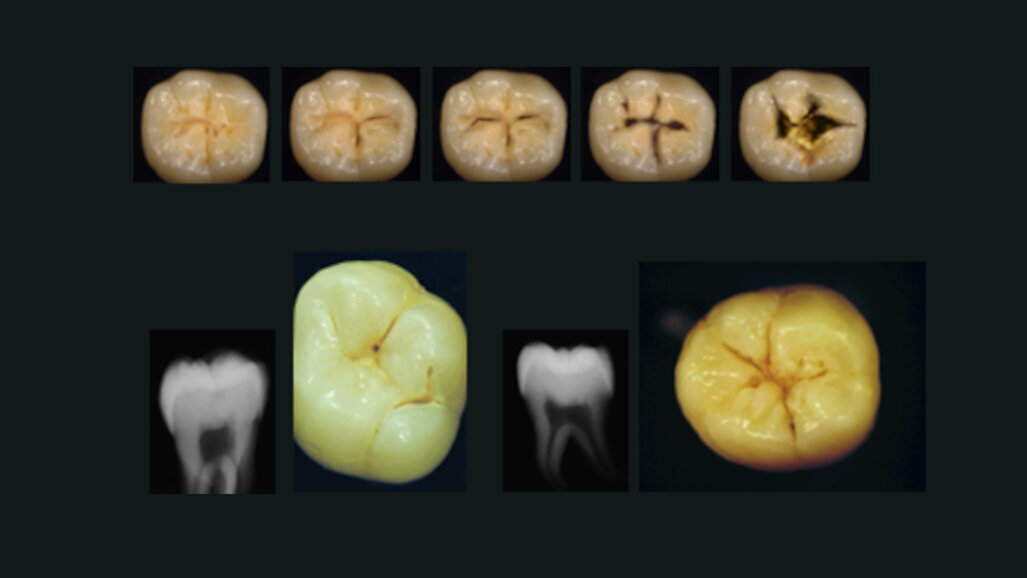 Enquête ReCol : le diagnostic et le traitement des lésions carieuses proximales et occlusales
