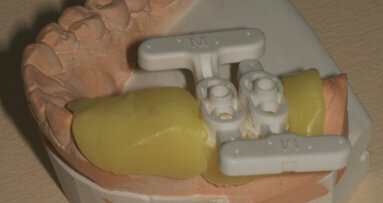 Intégration de la CFAO globale au quotidien : implantologie guidée par CEREC Guide et couronne usinée sur TiBase