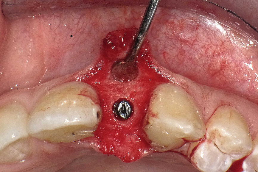 Fig. 6 : Les implants (Bicon Dental Implants) sont insérés jusqu’à 2–3 mm sous le niveau de la crête. Une vis de cicatrisation en PTFE noir d’une épaisseur de 2 mm protège l’implant pendant la période de cicatrisation. 
