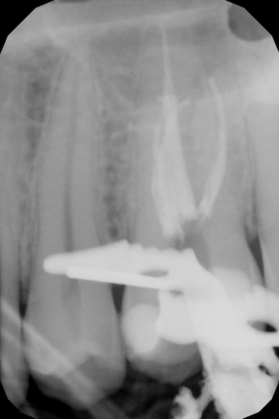 Fig.4 - Rx-periapicale di controllo post-operatoria.