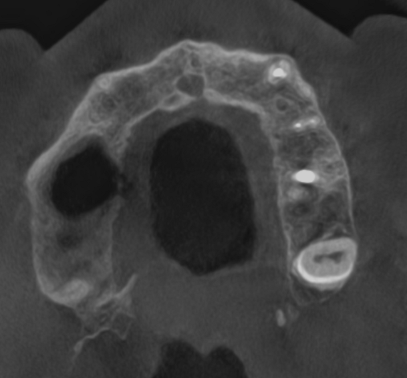 Fig. 9b: Low-level transversal cross-section of the maxilla showing the completely healed maxillary sinus.
