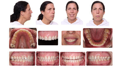 Case study: Class I crowded malocclusion with moderate maxillary and mandibular crowding