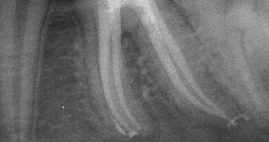 Clinical opinion: Well-thought-out simplicity leads to superior obturation