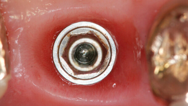 Vantaggi clinici del carico immediato con impianto Cono Morse