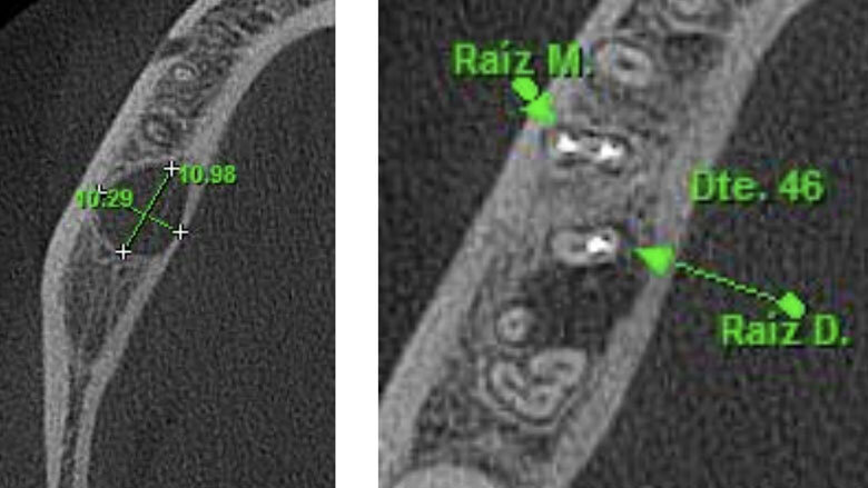 Figura 1. Inclinación de la raíz distal del primer molar inferior derecho hacia lingual. Ubicada aproximadamente a 10 mm de la cortical ósea vestibular, lo que hace imposible hacer el abordaje quirúrgico a través de microcirugía.