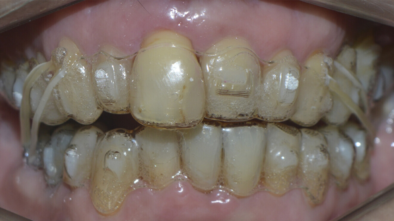 Fig. 9: Treatment with aligners. 