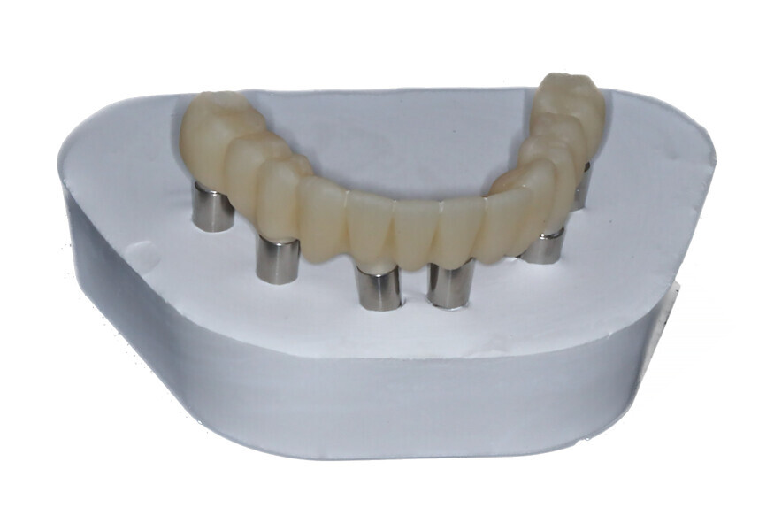 Fig. 15f: 3D-printed maxillary and mandibular restorations on verification casts.