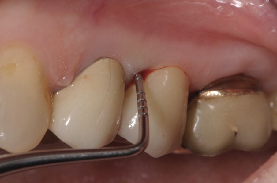 Fig. 1 - Sondaggio parodontale della lesione mesio-vestibolare del dente 2.5.