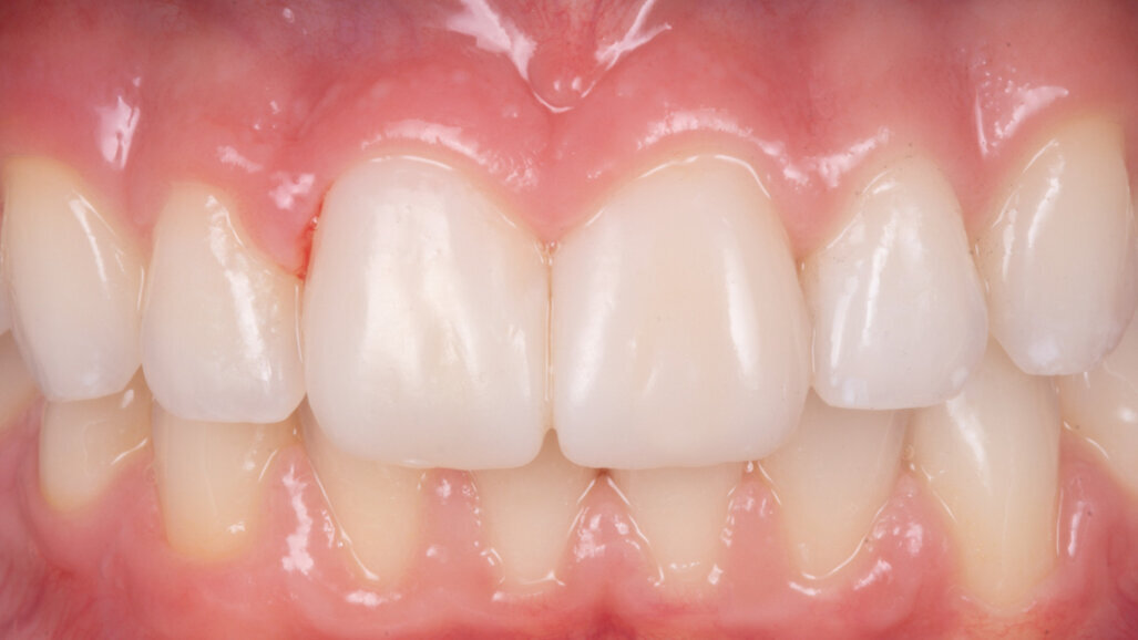 Facettes réalisées en méthode directe avec la technique du composite injecté