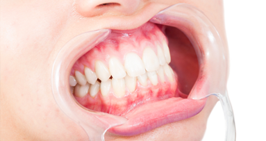 Expertentipp: Wichtige Aspekte zum Thema Full-Mouth-Disinfection