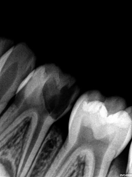 Fig. 10 : Radiographie initiale.