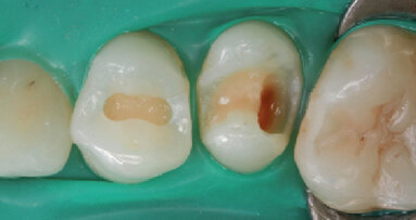 Vysoce kvalitní výplně. Moderní nano-hybridní kompozita – alternativa pro kavity všech tříd