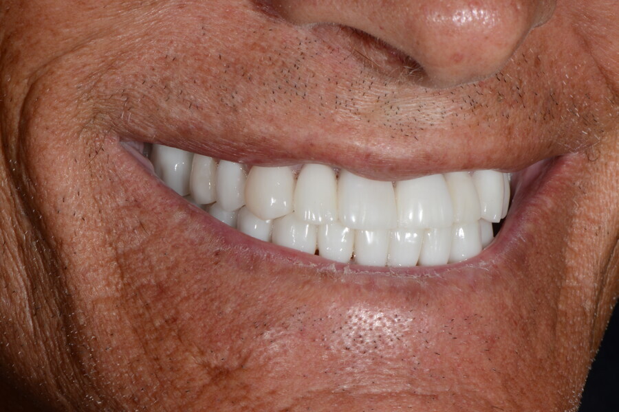 Fig. 32c: Right view of the patient’s final smile. 