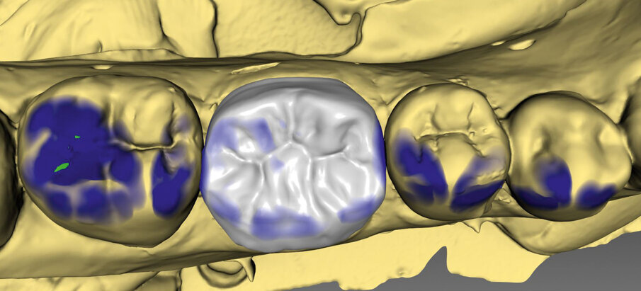 Fig. 3a: Crown design in the software suite (Cerec inLab) and try-in before crystallization firing (IPS e.max)