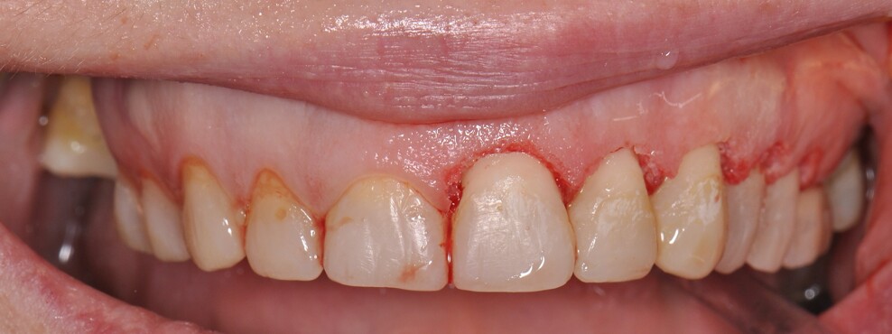 Fig. 3: Intra-operative view during laser-assisted crown lengthening using the Er:YAG laser.