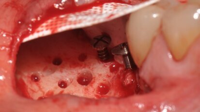 GBR Pocket Technique