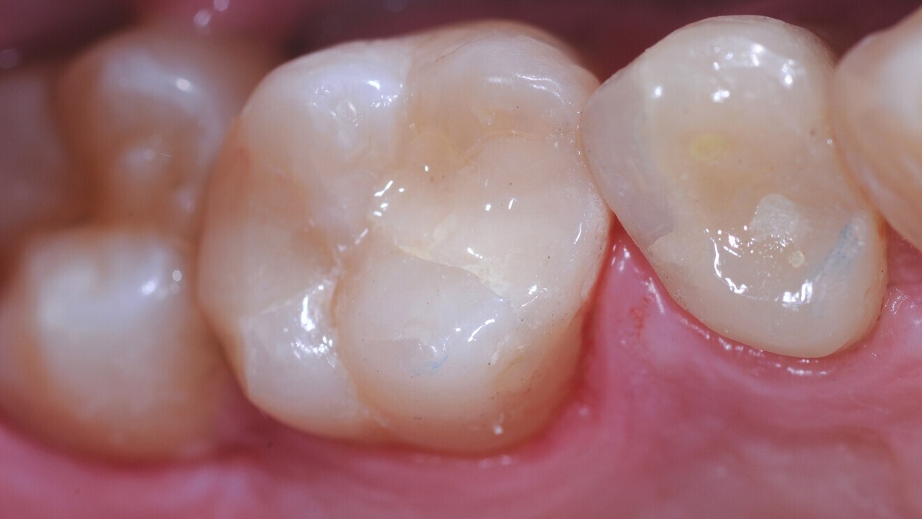 Fig. 8: Class II glass hybrid restoration with EQUIA Forte on tooth #26 after treatment.