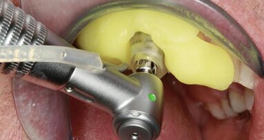 One-visit guided treatment thanks to CAD/CAM and CBCT