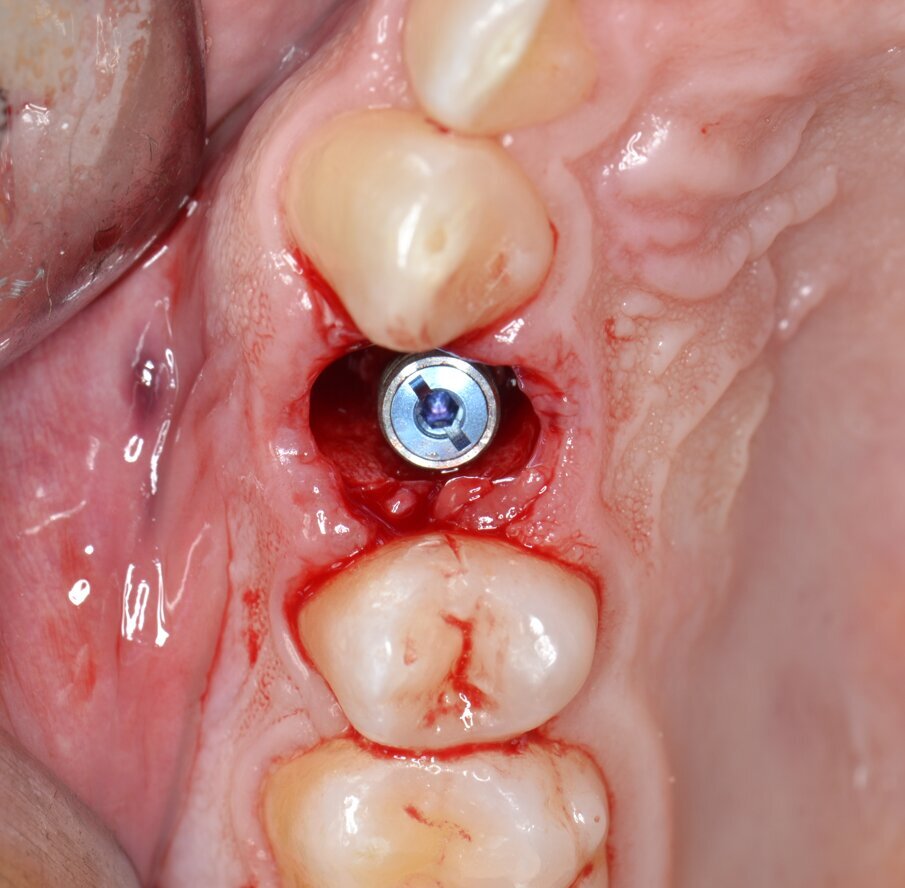 Fig. 10 - Impianto inserito in posizione protesicamente corretta (IT > 55N.cm).