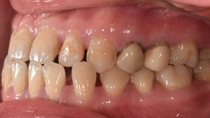 Precise, simple and fast aligner treatment: Power of shape memory
