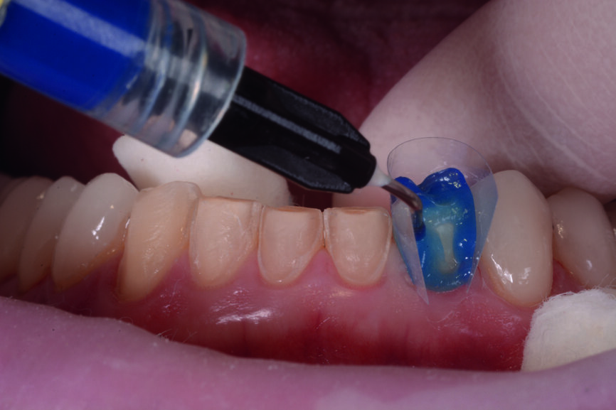 Figs. 11 et 12 : Les couronnes (11–13 et 21–23) et les facettes (14–17, 24–27, 31–37 et 41–47) sont collées sur les dents piliers avec une colle composite photopolymérisable (Futurabond U et Bifix QM).