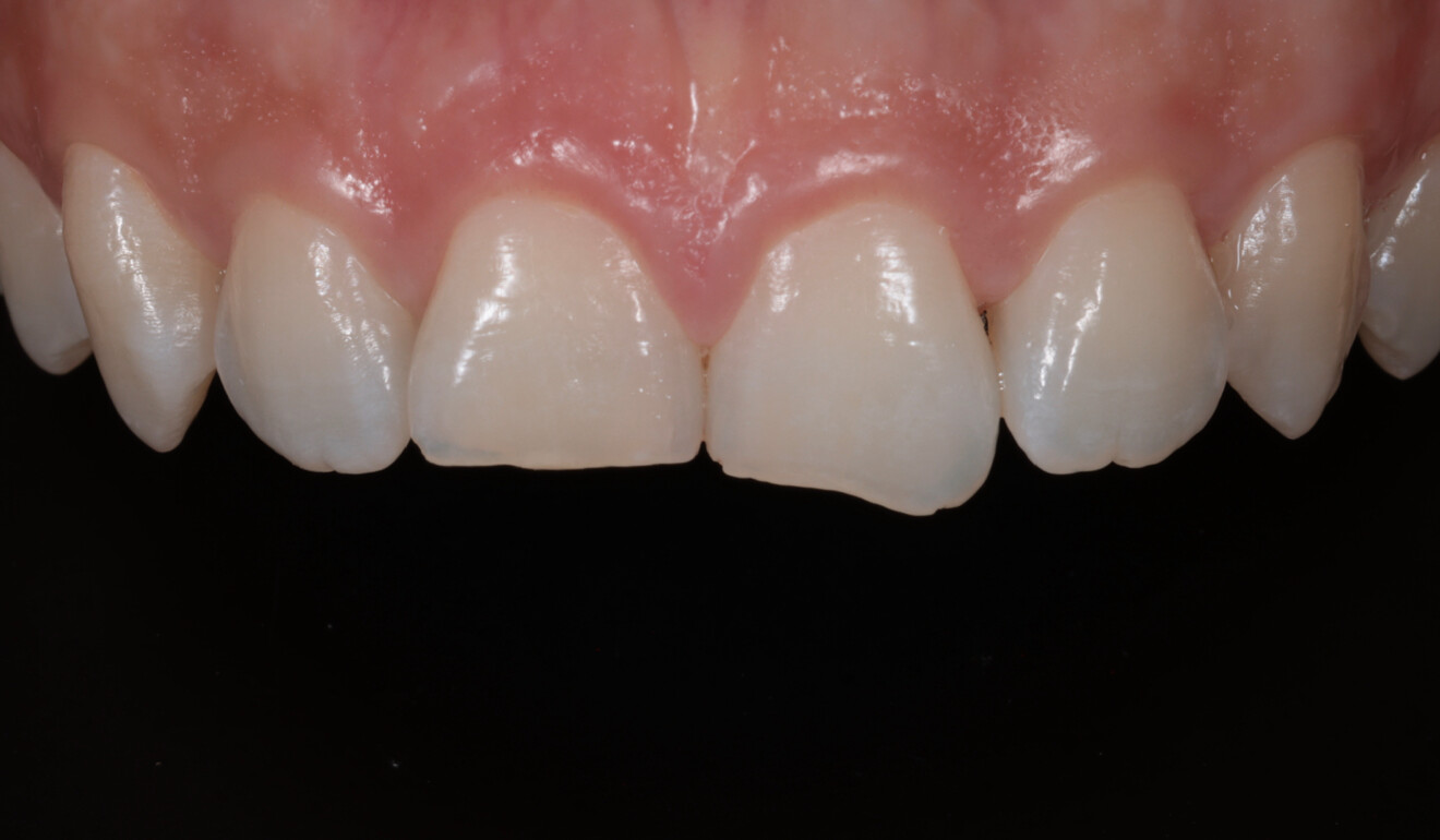 Fig. 2: Close-up of the maxillary incisors requiring restoration.