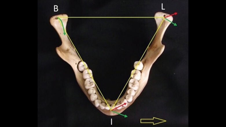 Condylar retrusion on the horizontal plane associated with retrusive lateral excursion