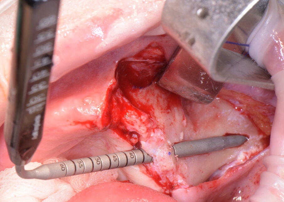 Fig. 15 - Misura della profondità della preparazione ultimata.