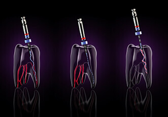 FKG Dentaire – XP-endo Solutions