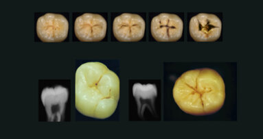 Enquête ReCol : le diagnostic et le traitement des lésions carieuses proximales et occlusales