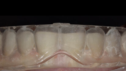 Fig. 3: A silicone mould was used for the flowable injection technique to restore the teeth with flowable composite. The silicone injection mould had injection channels prepared and was placed to check for proper fit.