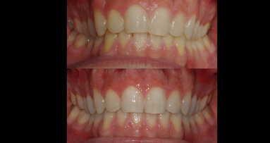 Valutazione clinica dello sbiancamento combinato post Invisalign: case report