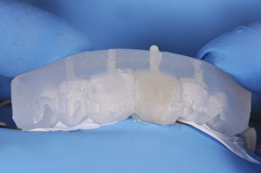 Fig. 18: CLEARFIL MAJESTY ES Flow Low in the shade A2 injected for the anatomical shaping of the maxillary right central incisor.