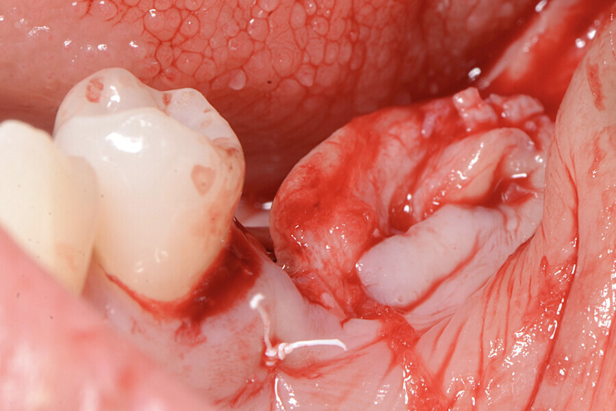 Fig. 13 : Greffe enfouie dans le bord de la gencive par la technique du rouleau. 