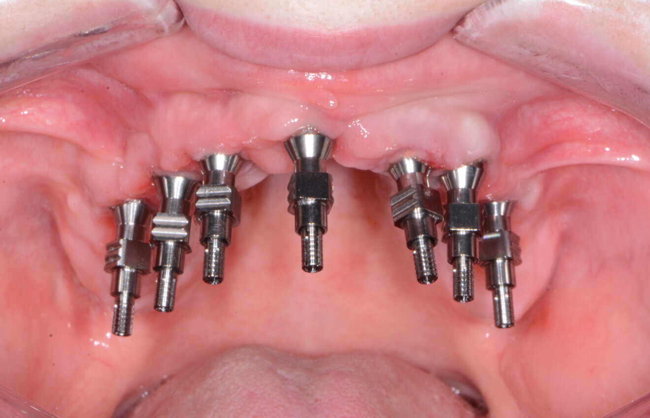 Fig. 13: Transmucosal impression posts.