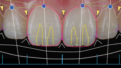 Curso intensivo práctico de carillas cerámicas y poliméricas Curso intensivo práctico de carillas cerámicas y poliméricas