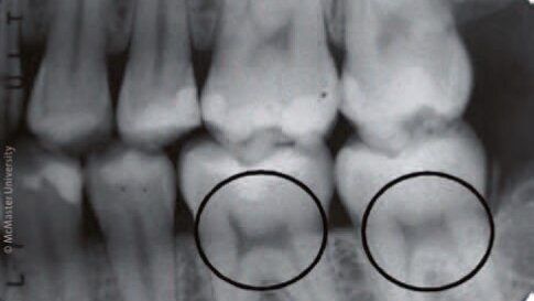 Zobni rentgen lahko razkrije pomanjkanje vitamina D