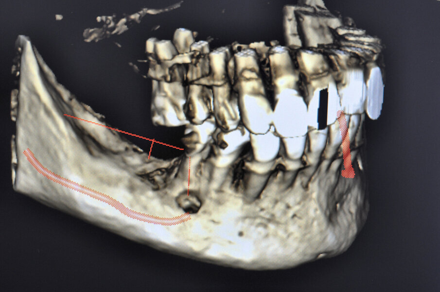 Figg. 1, 2_L’immagine clinica preoperatoria pone in evidenza un ampio difetto osseo sia orizzontale che verticale.