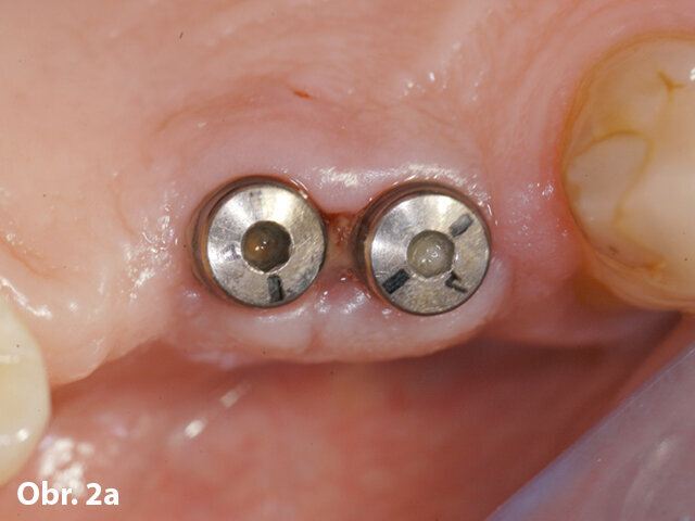 Obr. 2a: Původní situace po implantačním zákroku