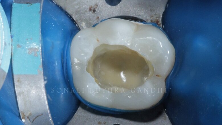 Fig 4: Orifices sealed with RMGIC