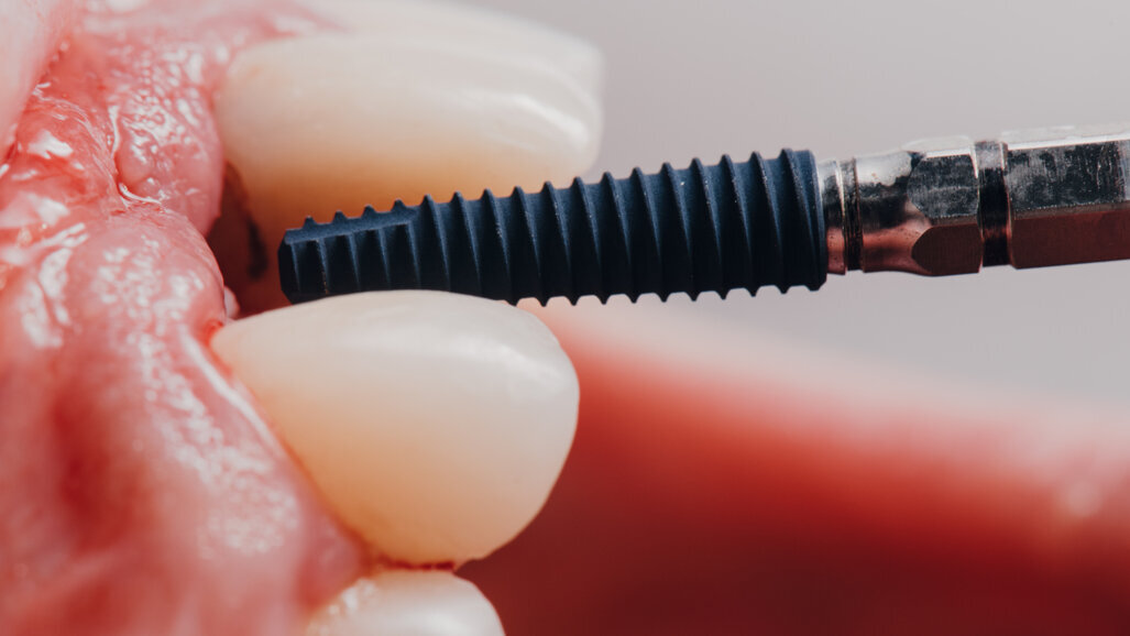 Over 10,000 dental implants placed using Yomi robotic system