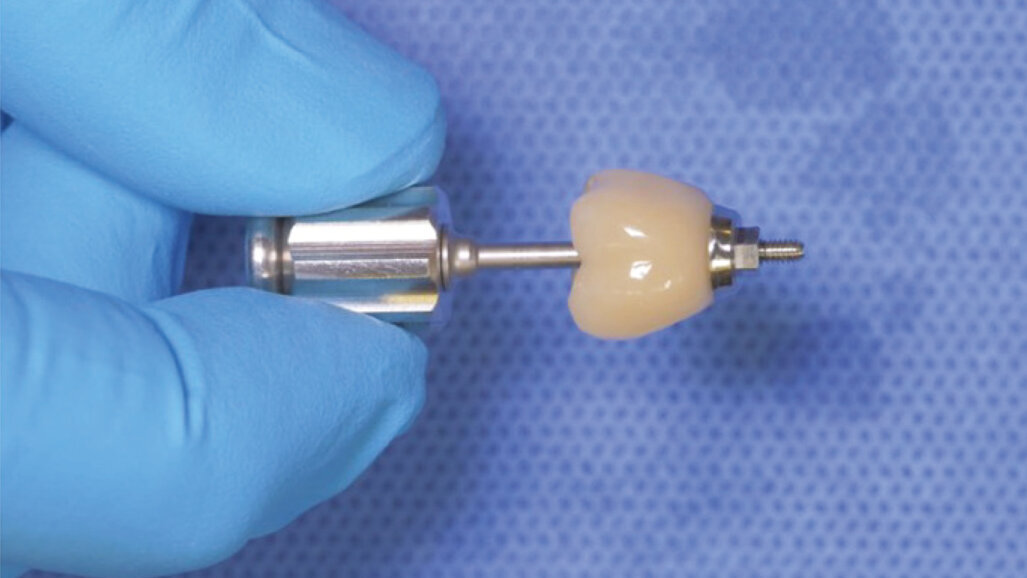 Titanium base implant cementation technique using PANAVIA SA Cement Universal