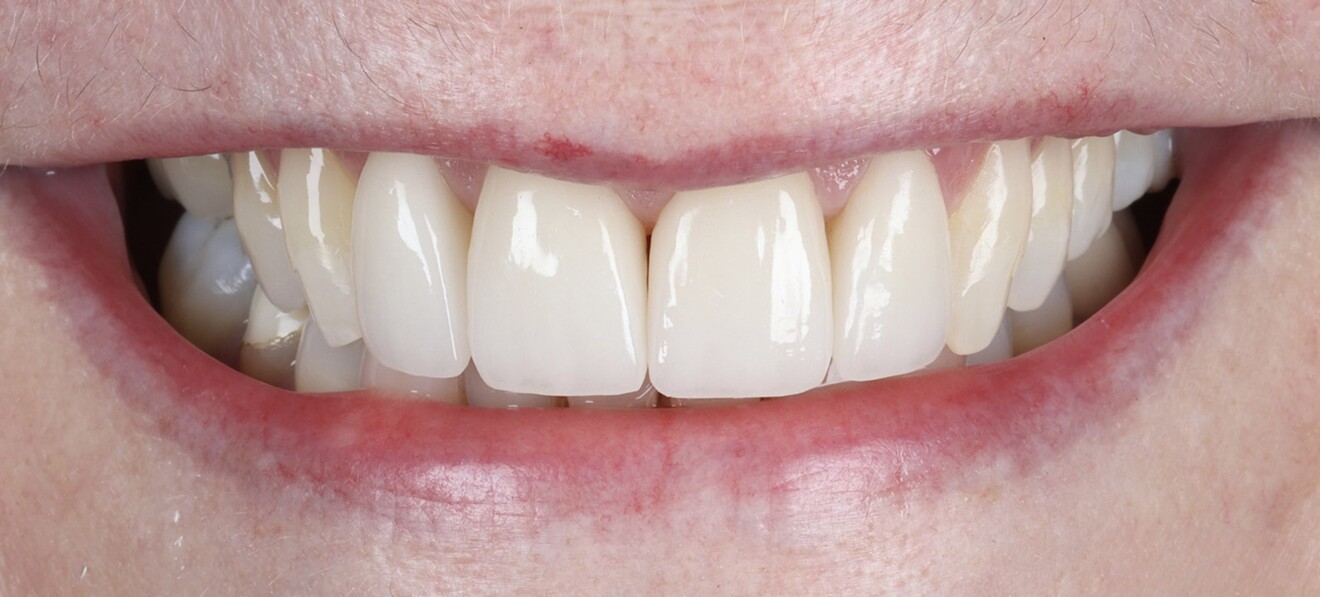 Fig. 24a: Final aesthetic outcome. Frontal close-up view showing symmetry and surface texture.