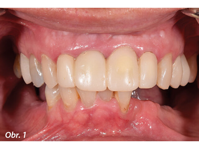 Obr. 1: Intraorální vzhled stavu chrupu před ošetřením